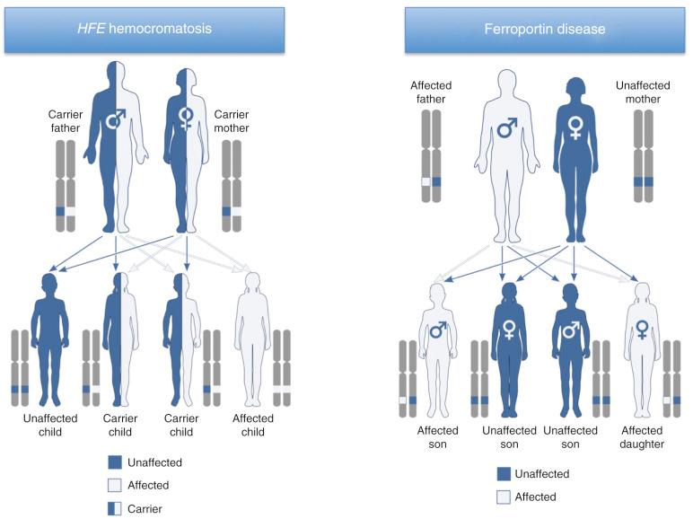 Fig. 60-6, The different inheritance patterns of the autosomal recessive HFE -associated hemochromatosis and the autosomal dominant ferroportin disease. See the text for details.