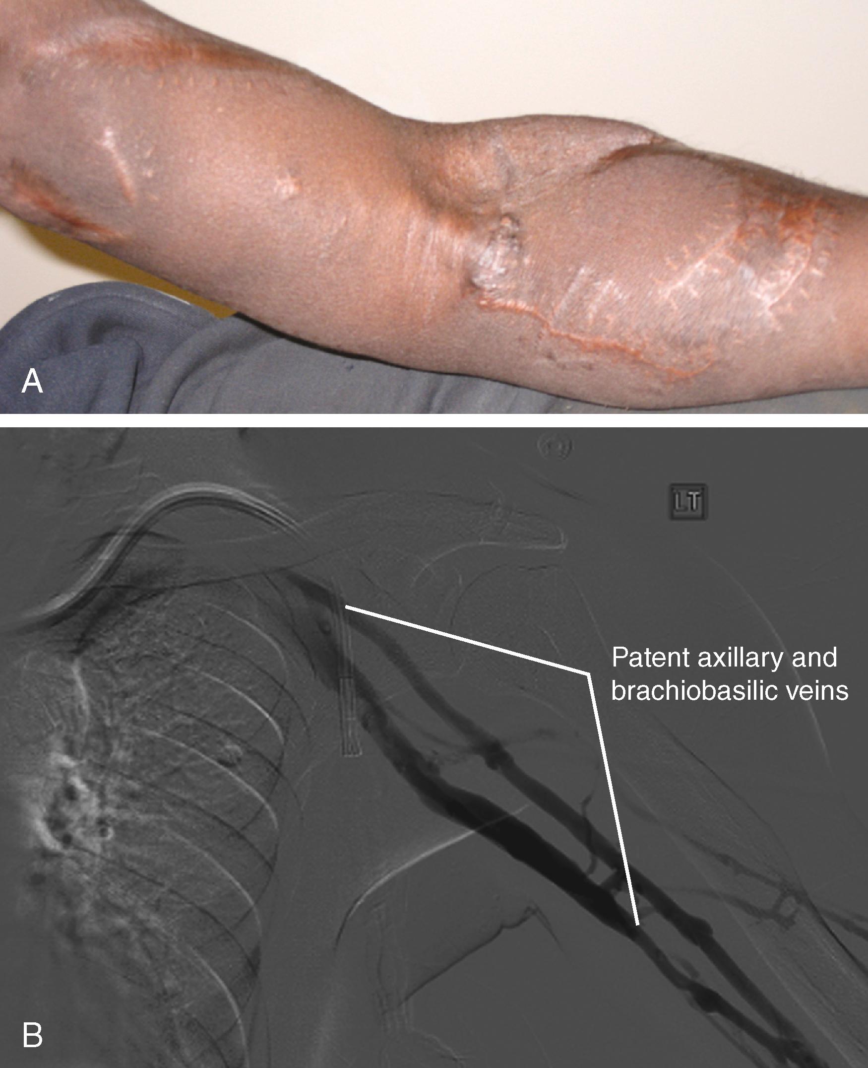 Figure 175.1, ( A ) Patient with failed prosthetic arteriovenous (AV) accesses in the left forearm and upper arm referred for the establishment of a new access. ( B ) A venogram was obtained to determine whether any alternative to a “complex” access was available in the left upper extremity. Despite the two previous upper extremity AV access procedures, the brachiobasilic, axillary, and central veins were widely patent. A successful brachiobasilic transposition was performed.