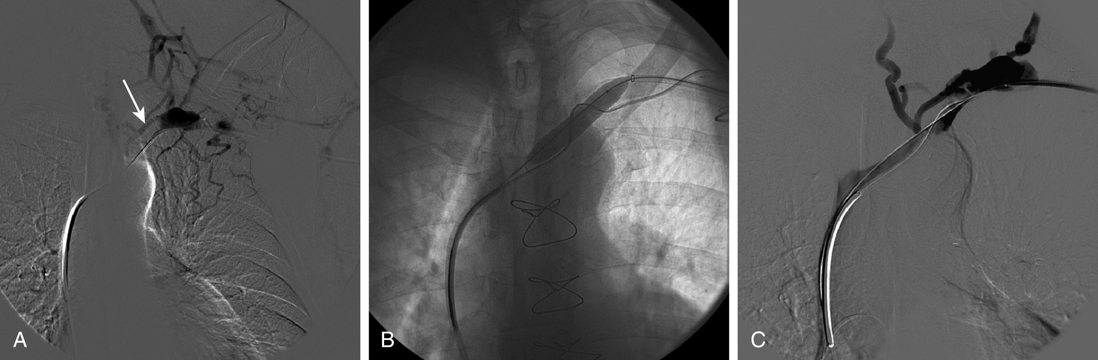 Figure 175.2, ( A ) Venography of the left upper extremity in a patient with an autogenous brachiocephalic arteriovenous access and symptoms of venous hypertension demonstrates chronic occlusion of the subclavian vein (arrow) . ( B ) The subclavian vein occlusion was crossed with a wire, and angioplasty was successfully performed with a high-pressure balloon. ( C ) Completion venography demonstrating patency of the central veins.