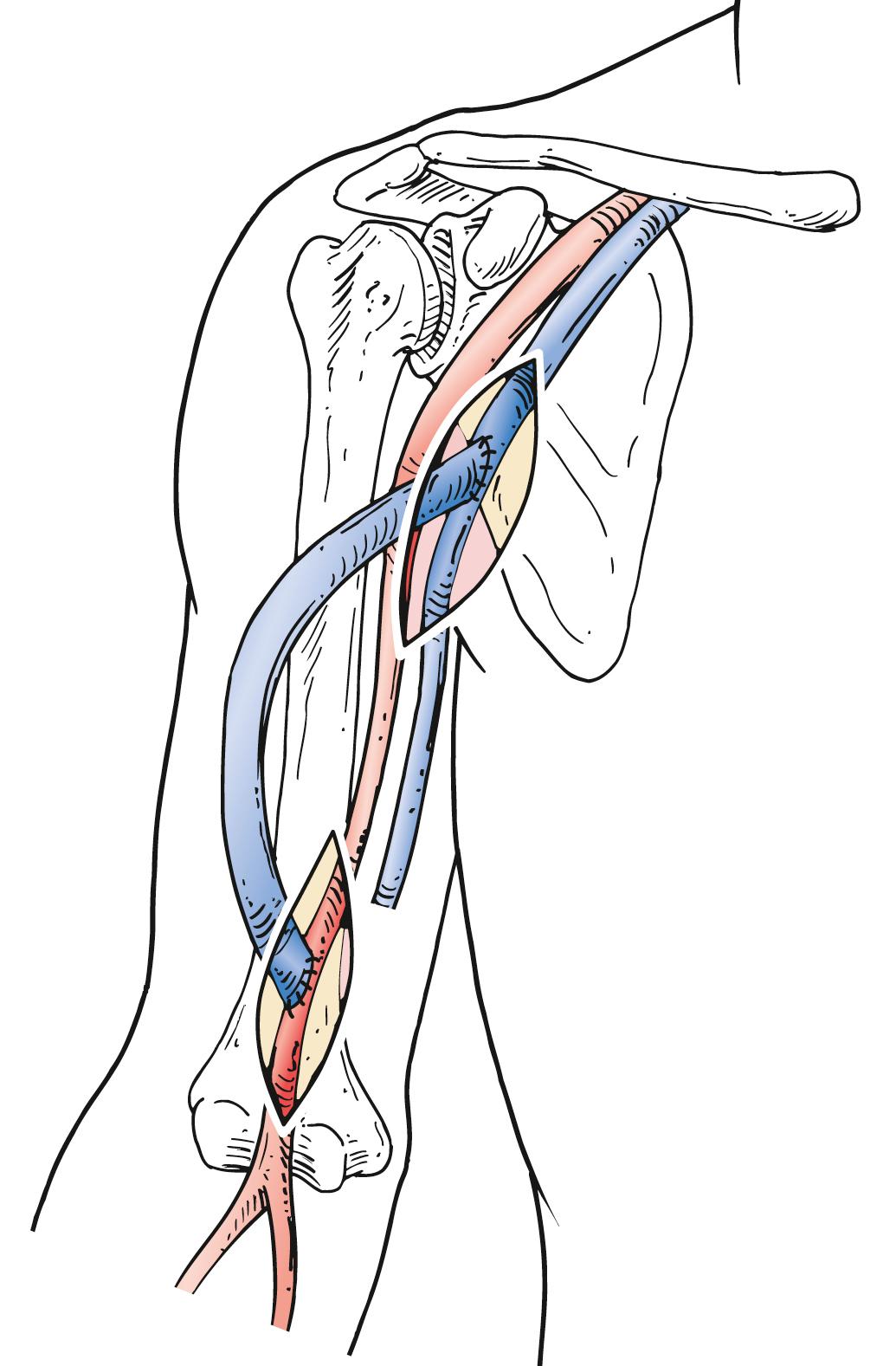 Figure 175.3, Brachioaxillary arteriovenous access using the reversed translocated femoral vein.