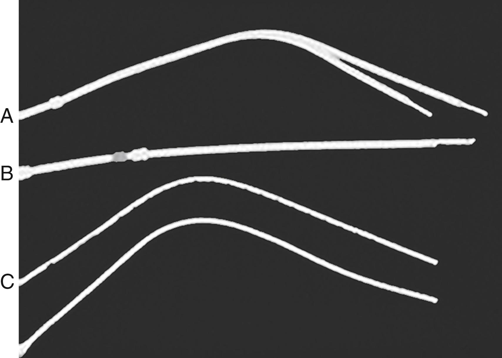 Figure 176.1, Three types of tunneled hemodialysis catheters: split-tip catheter ( A ), staggered-tip or step-tip catheter ( B ), and dual catheter ( C ).