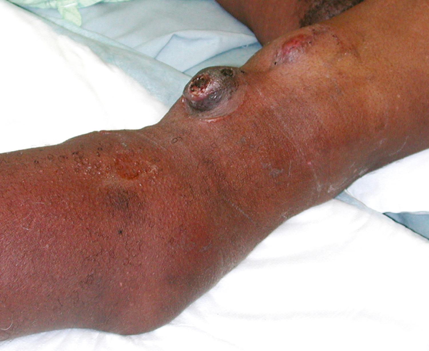 Figure 177.3, Repeated cannulation at the same site resulted in a pseudoaneurysm associated with infiltration and ulceration.
