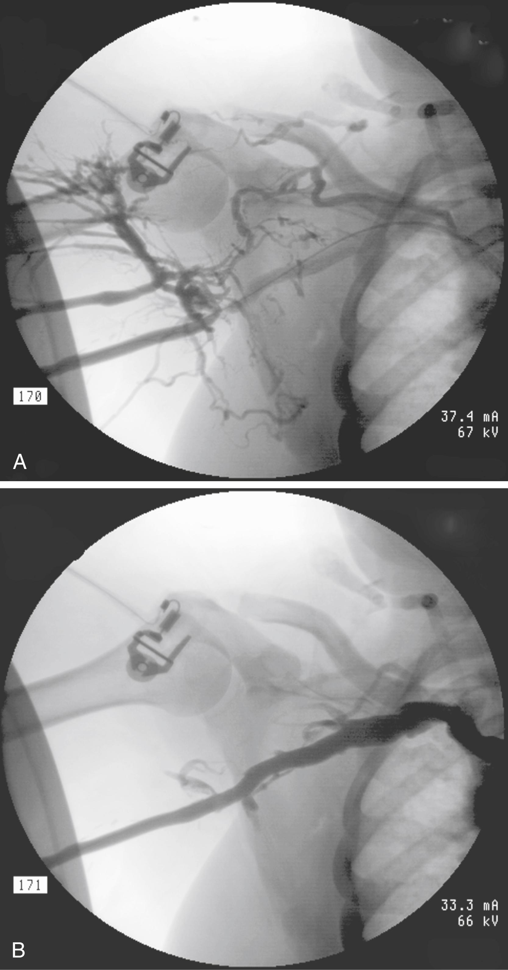 Figure 177.4, A stenosis in the axillary vein secondary to intimal hyperplasia is shown ( A ) before and ( B ) after successful treatment with an 8-mm high-pressure angioplasty balloon. Note the resolution of the venous collaterals.