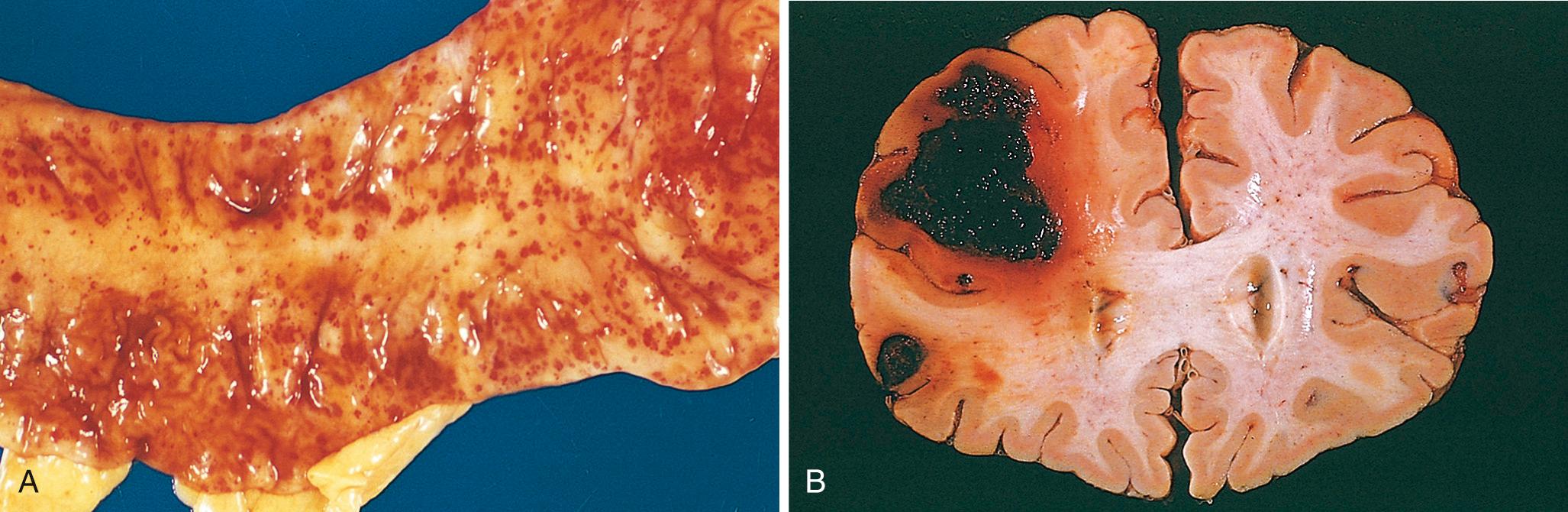 Figure 4.11, (A) Punctate petechial hemorrhages of the colonic mucosa, a consequence of thrombocytopenia. (B) Fatal intracerebral bleed.