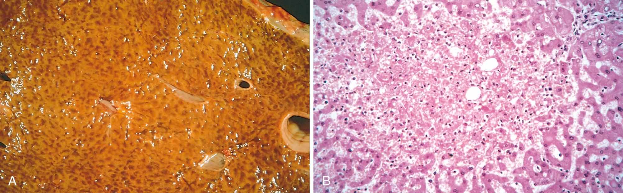 Figure 4.3, Liver with chronic passive congestion and hemorrhagic necrosis. (A) Central areas are red and slightly depressed compared with the surrounding tan viable parenchyma, forming a “nutmeg liver” pattern (so-called because it resembles the cut surface of a nutmeg). (B) Centrilobular necrosis with degenerating hepatocytes and hemorrhage.