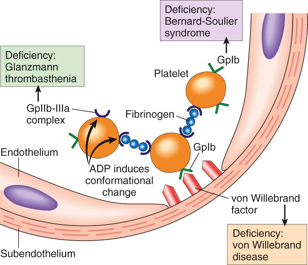 Figure 4.5, Platelet adhesion and aggregation. Von Willebrand factor functions as an adhesion bridge between subendothelial collagen and the glycoprotein Ib (GpIb) platelet receptor. Aggregation is accomplished by fibrinogen bridging GpIIb-IIIa receptors on different platelets. Congenital deficiencies in the various receptors or bridging molecules lead to the diseases indicated in the colored boxes. ADP, Adenosine diphosphate.