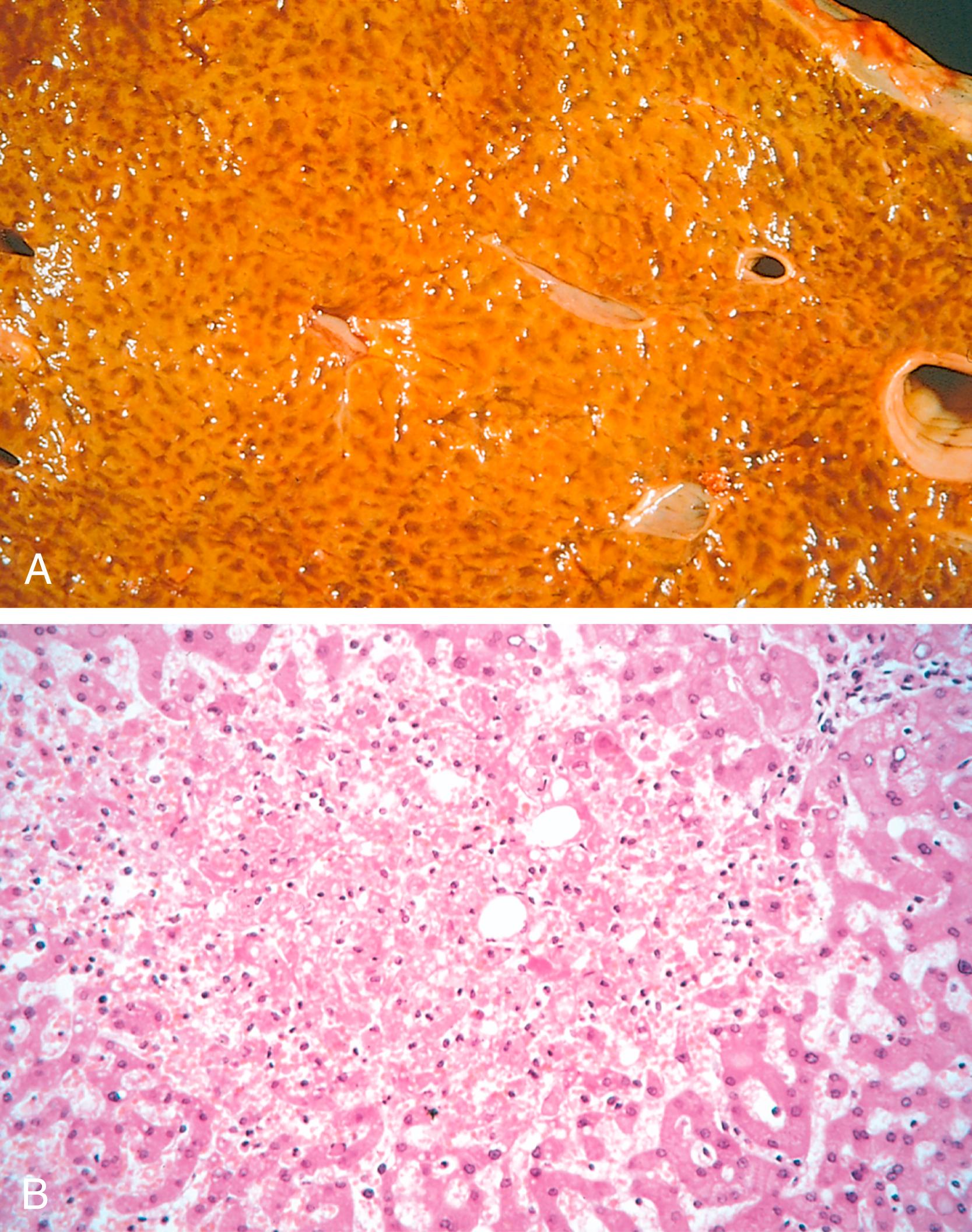 FIG. 3.1, Liver with chronic passive congestion and hemorrhagic necrosis. (A) In this autopsy specimen, centrilobular areas are red and slightly depressed compared with the surrounding tan viable parenchyma, creating “nutmeg liver” (so called because it resembles the cut surface of a nutmeg). (B) Microscopic preparation shows centrilobular hepatic necrosis with hemorrhage and scattered inflammatory cells. (Courtesy of Dr. James Crawford.)