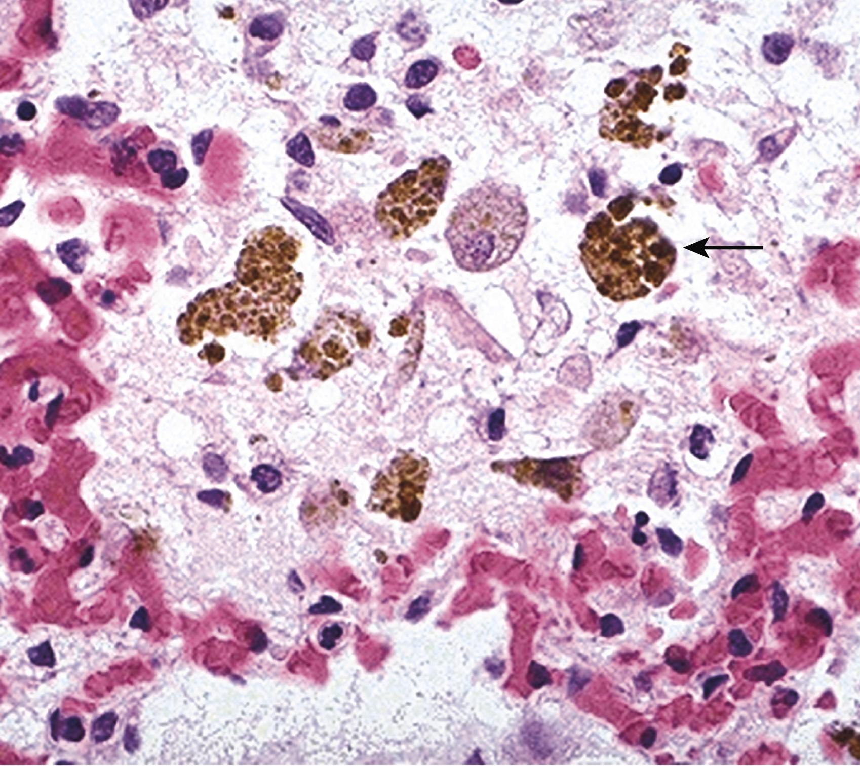 eFIG. 3.1, “Heart failure” cells. The alveolar space contains pinkish edema fluid and “heart failure cells,” macrophages with brown hemosiderin pigment (arrow) derived from phagocytosed red cells that leaked from congested capillaries.