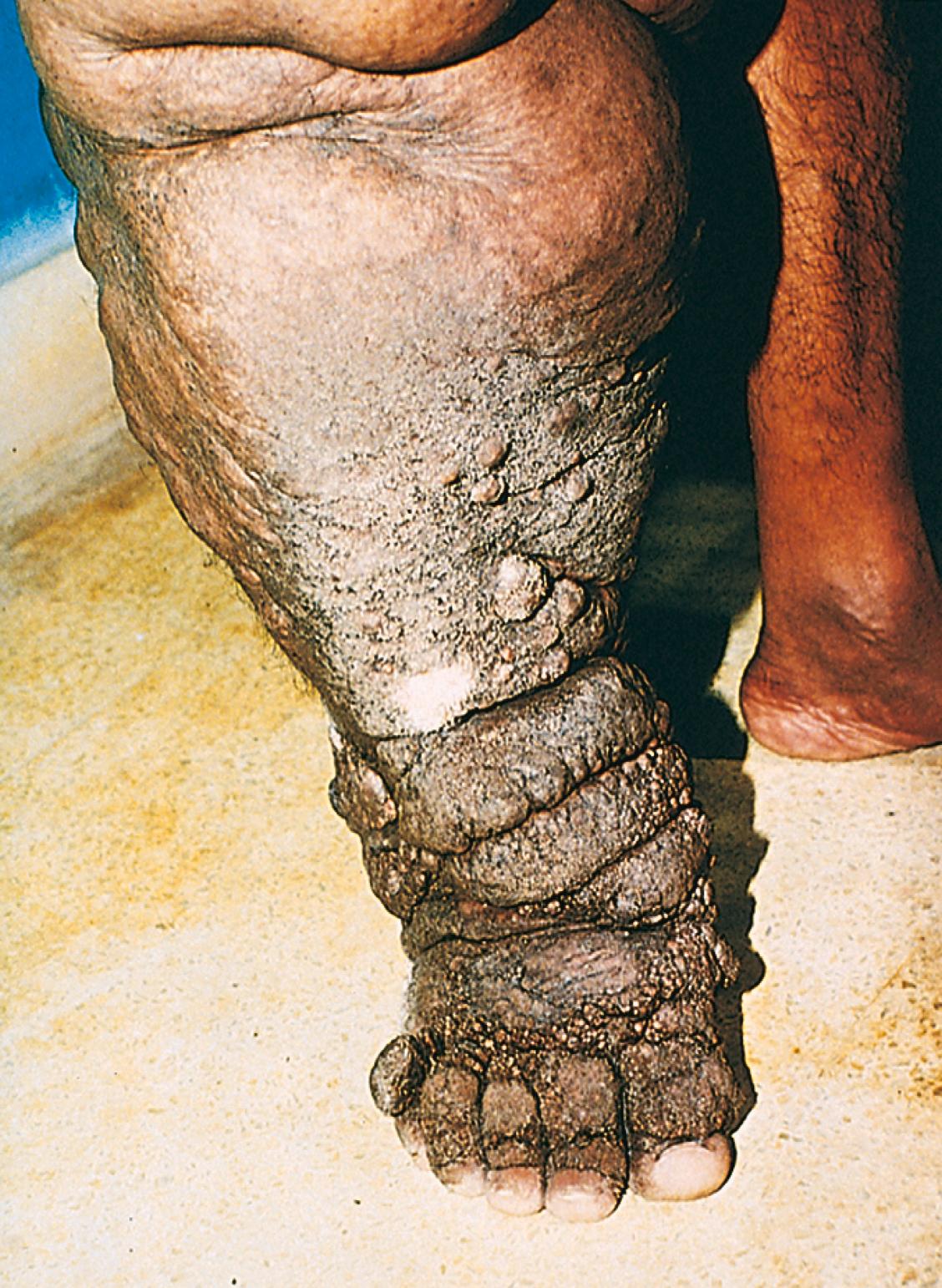 eFIG. 3.2, Massive edema and elephantiasis caused by filariasis of the leg.