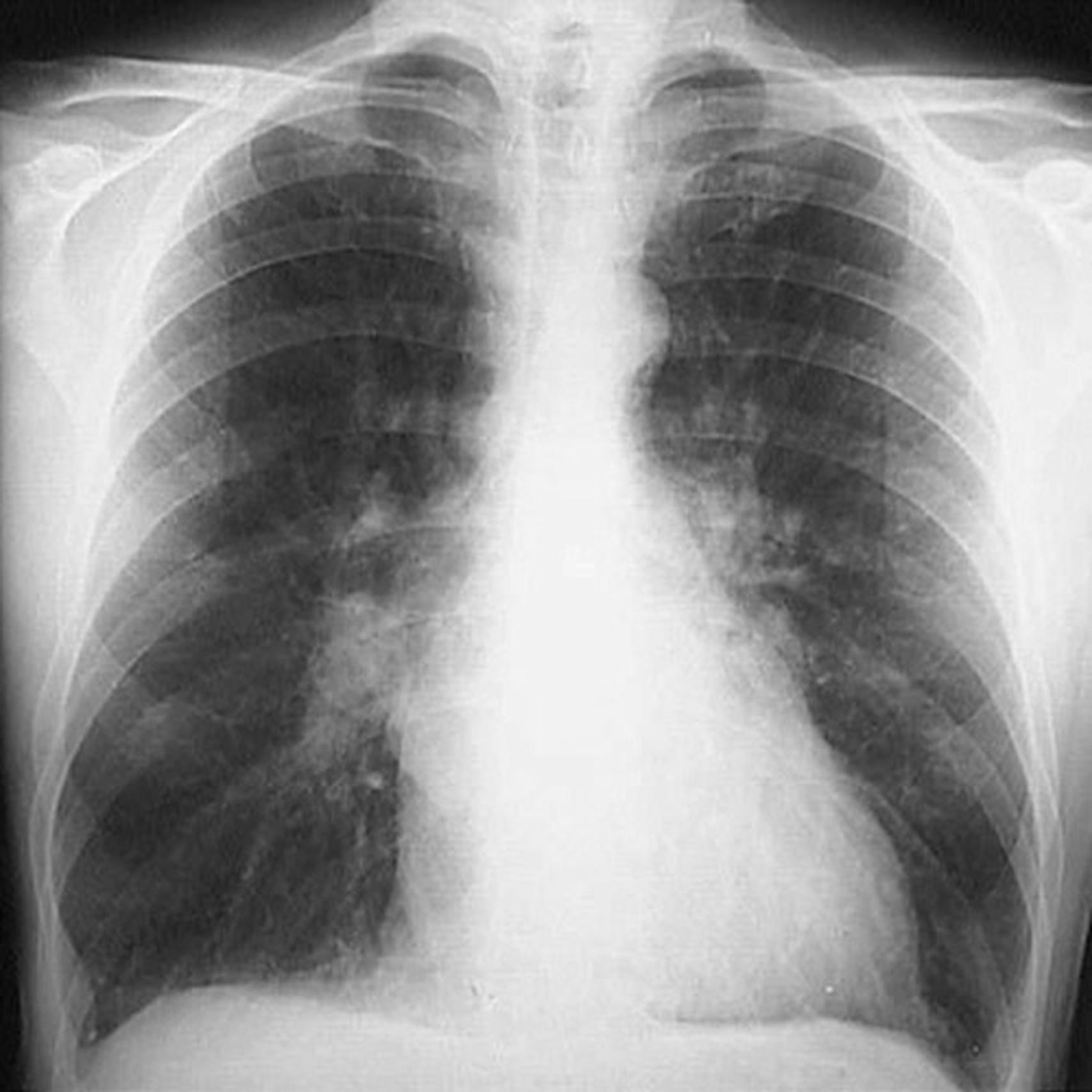 eFig. 3.3, Pulmonary edema. This chest x-ray in a patient with mitral stenosis shows increased lung markings, prominent pulmonary veins, and a prominent left heart border due to left atrial dilation.