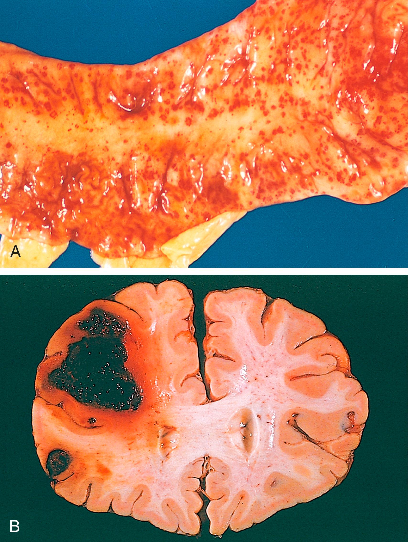 FIG. 3.4, (A) Punctate petechial hemorrhages of the colonic mucosa, a consequence of thrombocytopenia. (B) Fatal intracerebral hemorrhage.