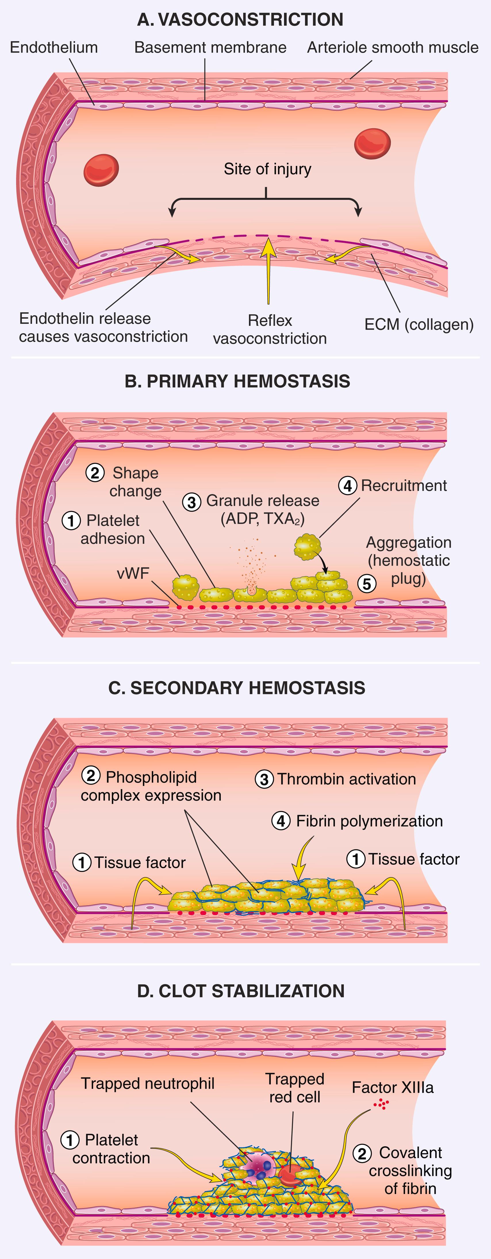 FIG. 3.5, Normal hemostasis. (A) After vascular injury, local neurohumoral factors induce a transient vasoconstriction. (B) Exposure of von Willebrand factor (vWF) in the extracellular matrix (ECM) leads to binding of platelets, which adhere and become activated, undergoing a shape change and releasing their granule contents. Released adenosine diphosphate (ADP) and thromboxane A 2 (TXA 2 ) induce additional platelet aggregation through bridging interactions involving fibrinogen and platelet receptor GpIIb-IIIa, leading to formation of the primary hemostatic plug. (C) Activation of the coagulation cascade results in fibrin polymerization, “cementing” the platelets into a secondary hemostatic plug. (D) Platelet contraction and covalent crosslinking of fibrin stabilize the clot.