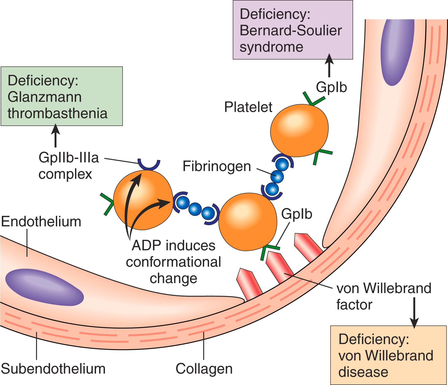 FIG. 3.6, Platelet adhesion and aggregation. Von Willebrand factor (vWF) functions as an adhesion bridge between subendothelial collagen and the glycoprotein Ib (GpIb) platelet receptor. Platelet aggregation is accomplished by fibrinogen binding to platelet GpIIb-IIIa receptors on different platelets. Congenital deficiencies in the various receptors or bridging molecules lead to the diseases indicated in the colored boxes. ADP, Adenosine diphosphate.