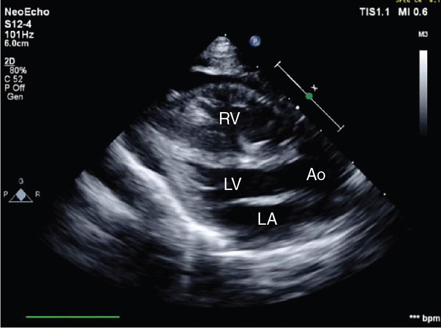 Fig. 24.1, Low parasternal long-axis view at end-systole in this severely hypovolemic baby.