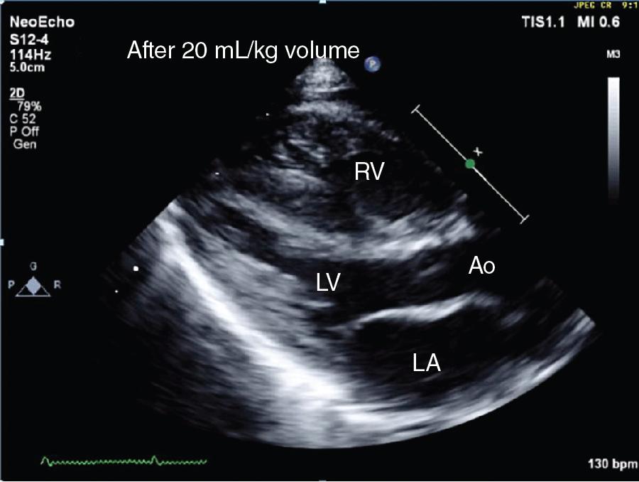 Fig. 24.2, Same view after giving 20 mL/kg of O-negative blood.