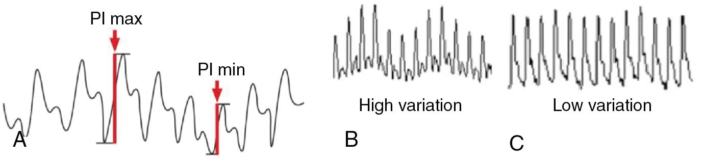 Fig. 28.2, Plethysmography variability index (PVI).