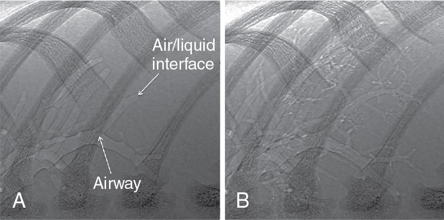 Fig. 6.1, High-resolution phase contrast X-ray images of a non-dependent region of the lung shortly after the beginning of lung aeration.