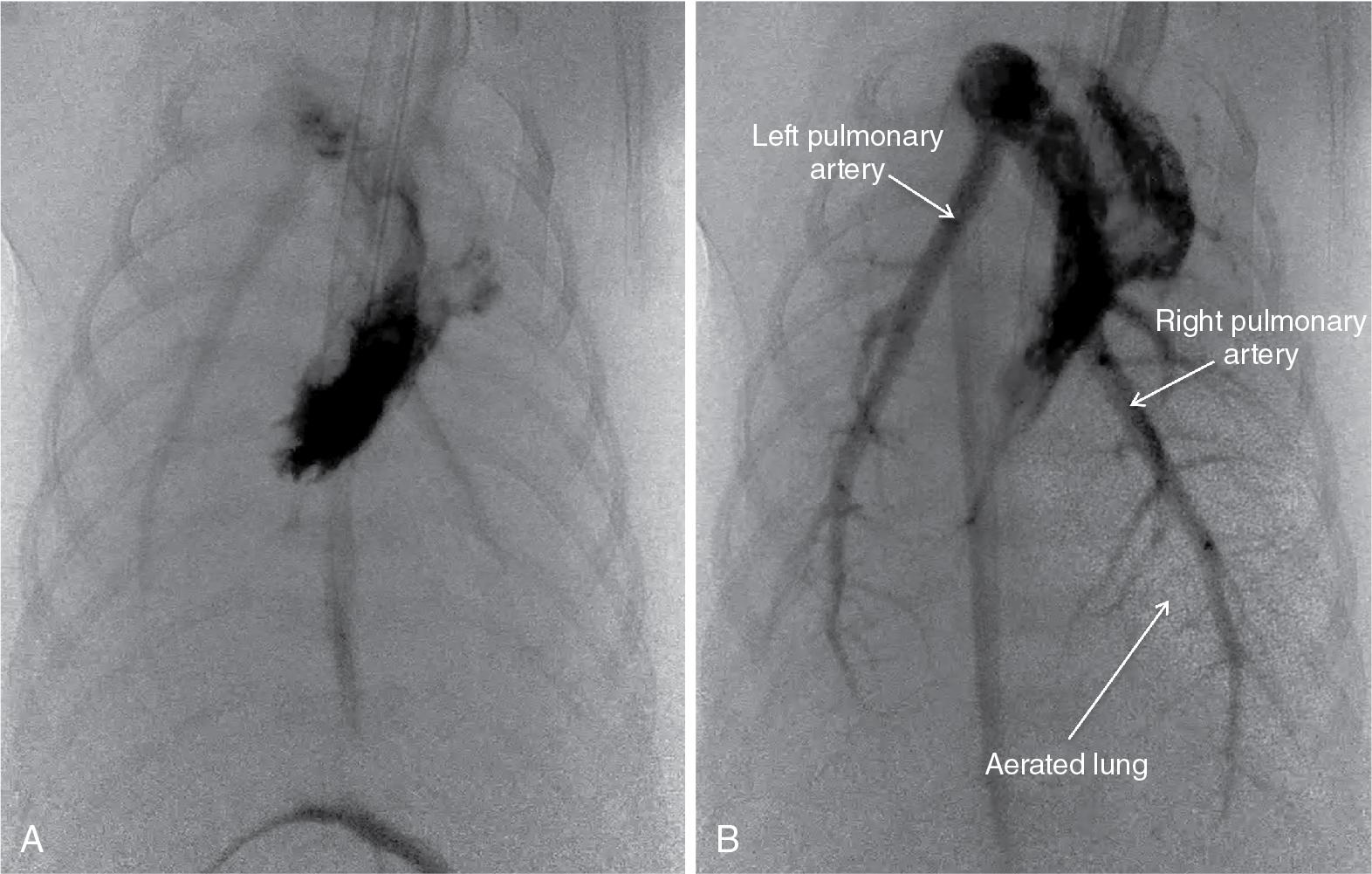 Fig. 6.2, Simultaneous phase contrast X-ray images and angiogram of a near-term newborn rabbit before (A) and after partial lung aeration of the right lung (B).