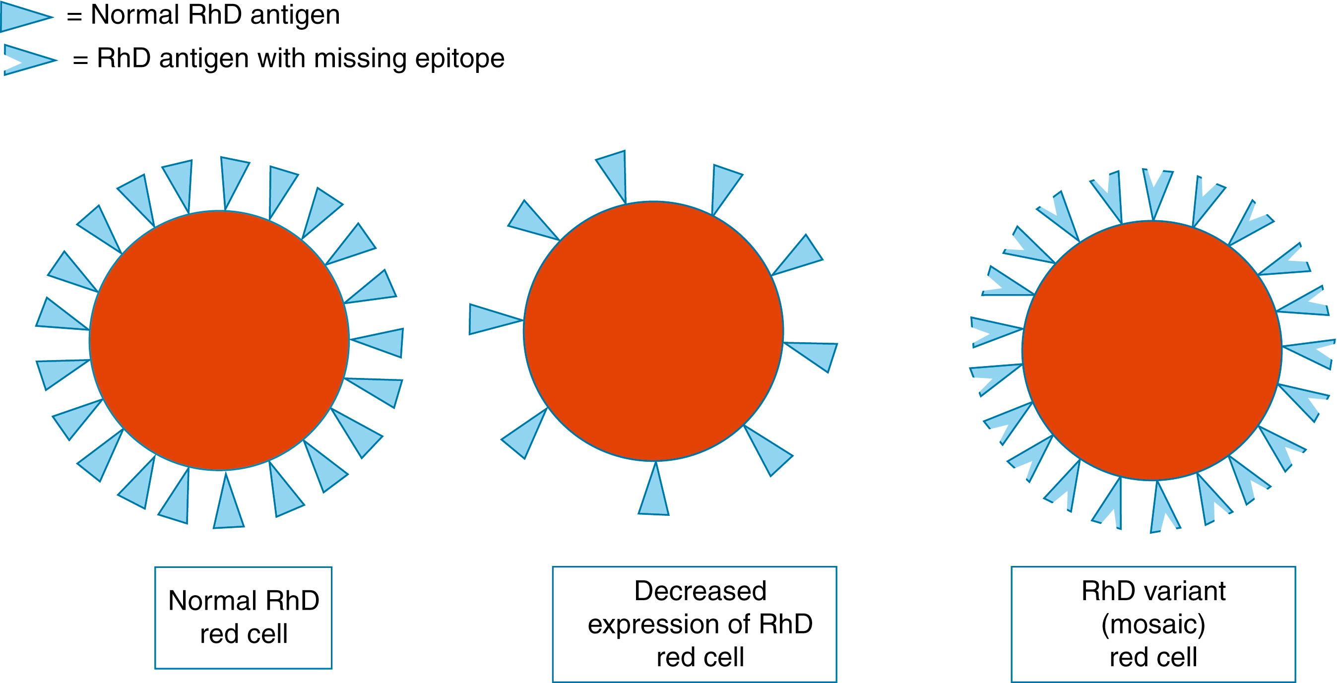 Figure 35.3, Diagram of RhD-positive red cell, weak D red cell with decreased expression of intact RhD antigens, and weak D mosaic RhD variant cell with missing RhD epitopes.