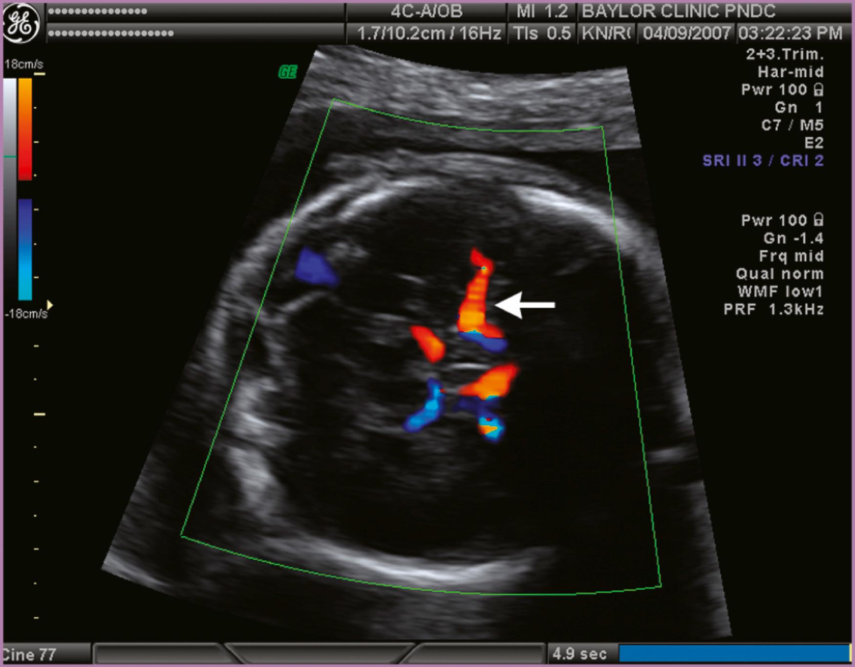 Figure 35.5, Middle cerebral artery showing location of Doppler gate.