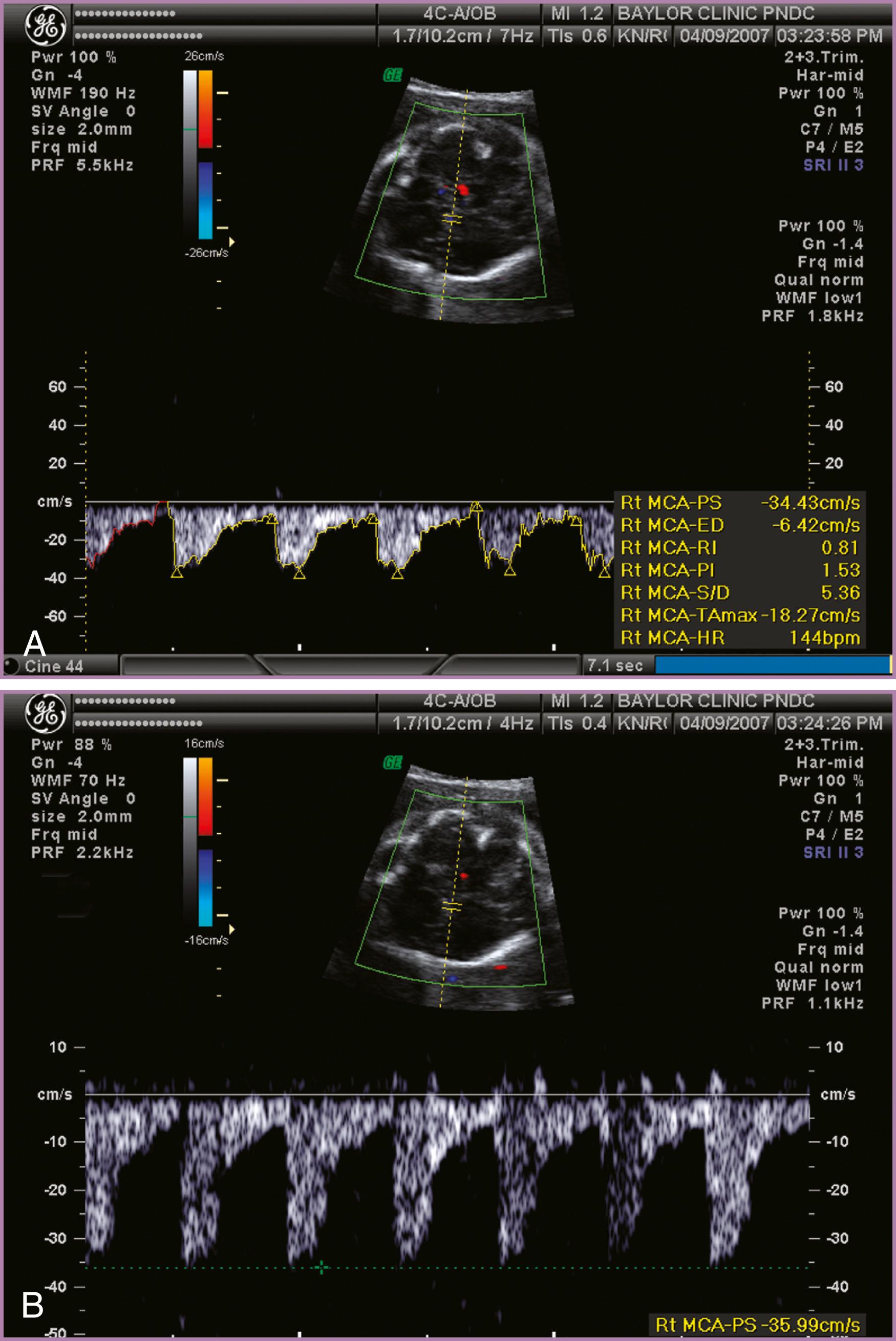 Figure 35.6, Optimization of Doppler parameters.