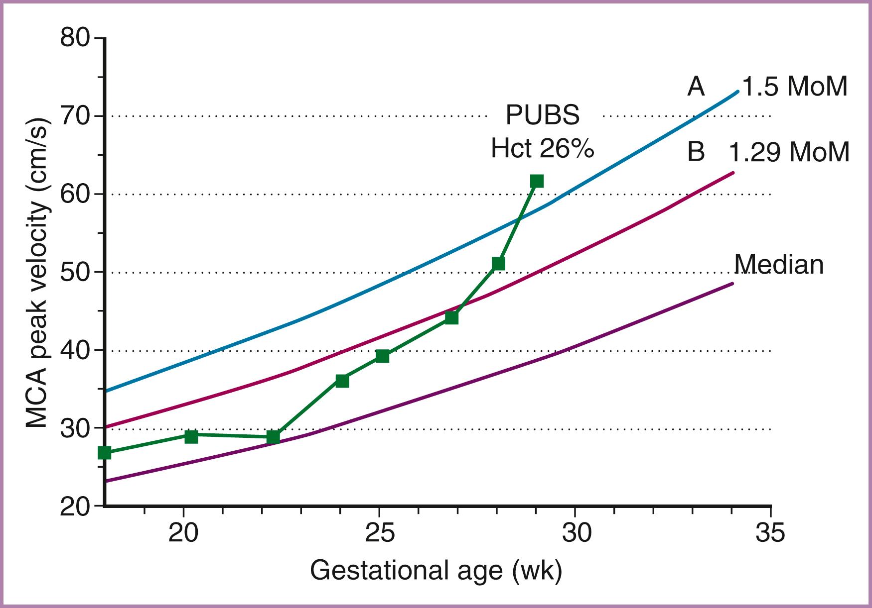 Figure 35.7, Serial Doppler determinations of the peak systolic velocity in the fetal middle cerebral artery (MCA).