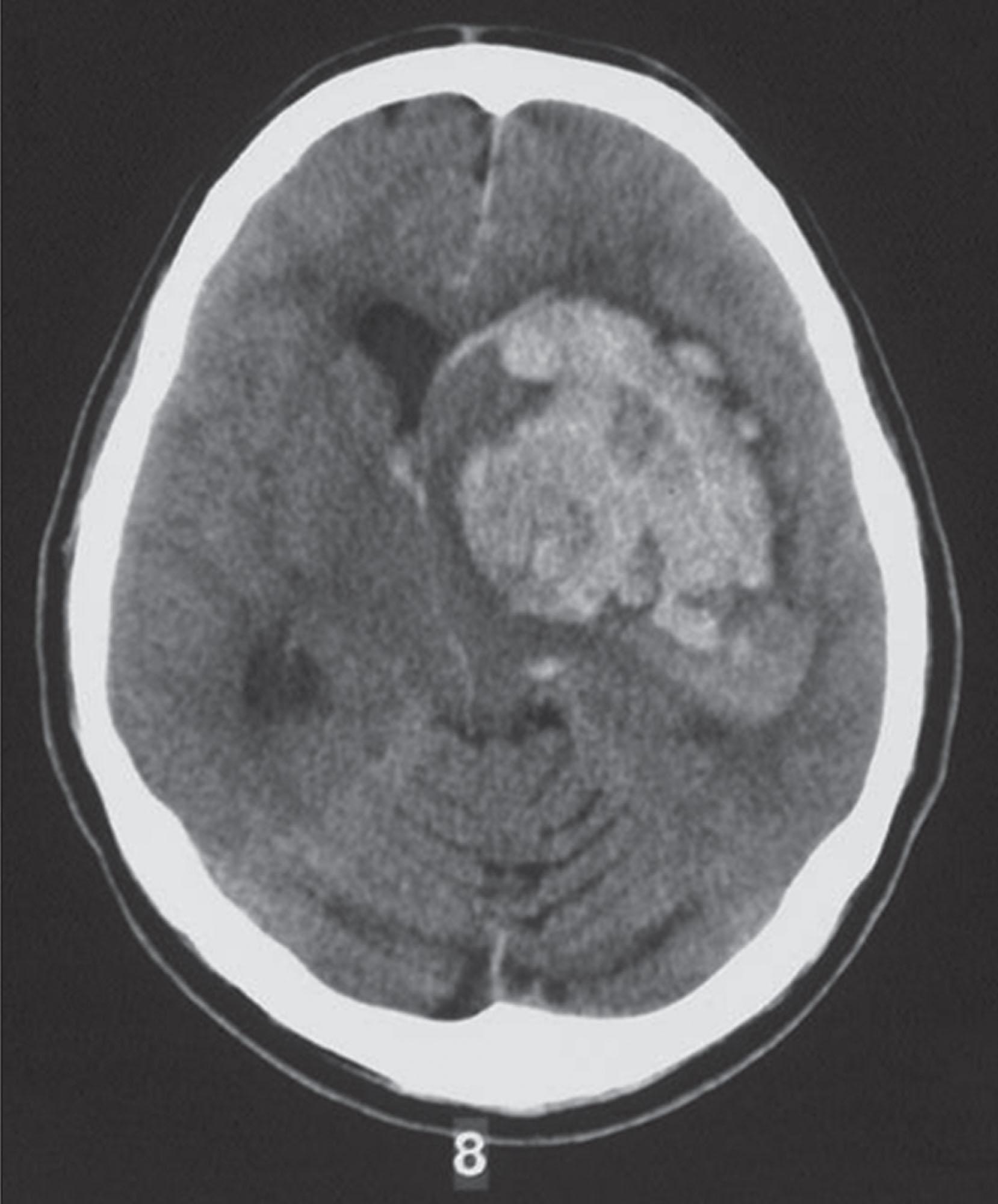 Figure 134.8, INTRACRANIAL BLEEDING IN HEMOPHILIA.