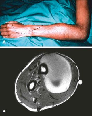 eFIGURE 73–1, Soft tissue hemorrhage. A , Clinical photograph depicting soft tissue swelling due to a hematoma compressing the radial nerve resulting in paresthesia (as demarcated by the ink markings). B , Axial T1-weighted MR image through the forearm shows an acute hematoma.