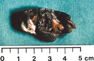 eFIGURE 73–2, Pseudotumor specimen. The predominant composition is dark material, indicative of hemosiderin deposition.