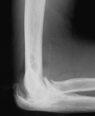 eFIGURE 73–3, Lateral radiograph of the elbow in a hemophiliac patient. There is elevation of the anterior and posterior fat pads indicating elbow joint effusion. There are accompanying degenerative changes, which can simulate Charcot changes.
