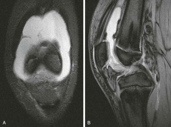 eFIGURE 73–4, Acute effusion. A , Coronal short tau inversion recovery MR image shows fluid in the suprapatellar pouch. B , Sagittal gradient-echo MR image depicts an acute hemarthrosis in a skeletally immature patient (shown is the unfused epiphysis).