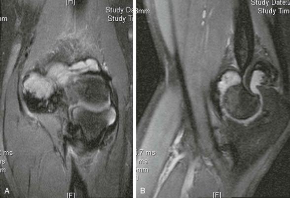 eFIGURE 73–5, Synovitis of the elbow joint. Coronal ( A ) and sagittal ( B ). The synovial thickening has a fluid signal and is hard to distinguish from joint effusion. The cloudlike lobulation is a clue that the mass is solid.