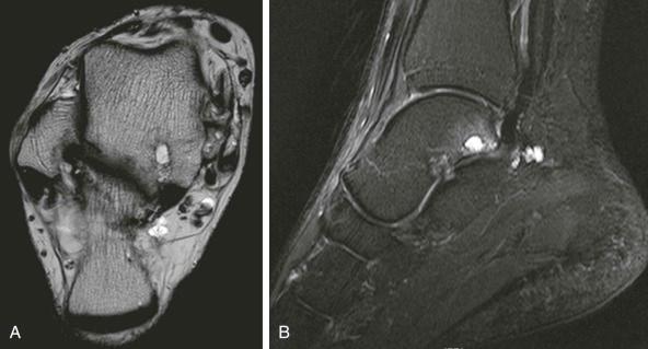 eFIGURE 73–6, Chronic hemophilic arthropathy of the posterior subtalar joint. The coronal T2-weighted image ( A ) shows artifact from hemosiderin deposition, joint space narrowing, and subchondral cysts. The sagittal fast short tau inversion recovery image ( B ) shows the cysts in bone and synovial hypertrophy posterior to the joint.