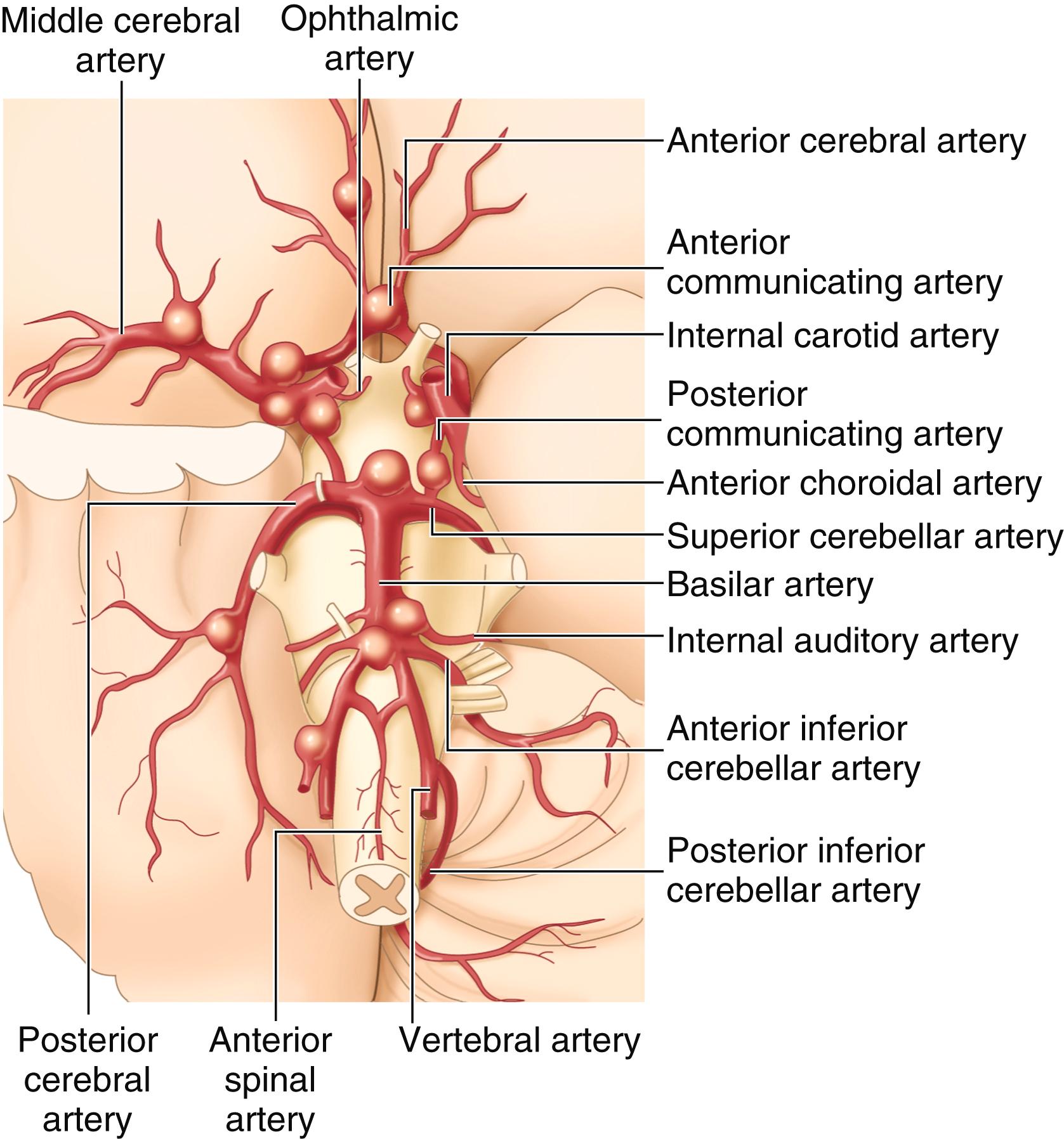 FIGURE 377-1, Saccular aneurysms.