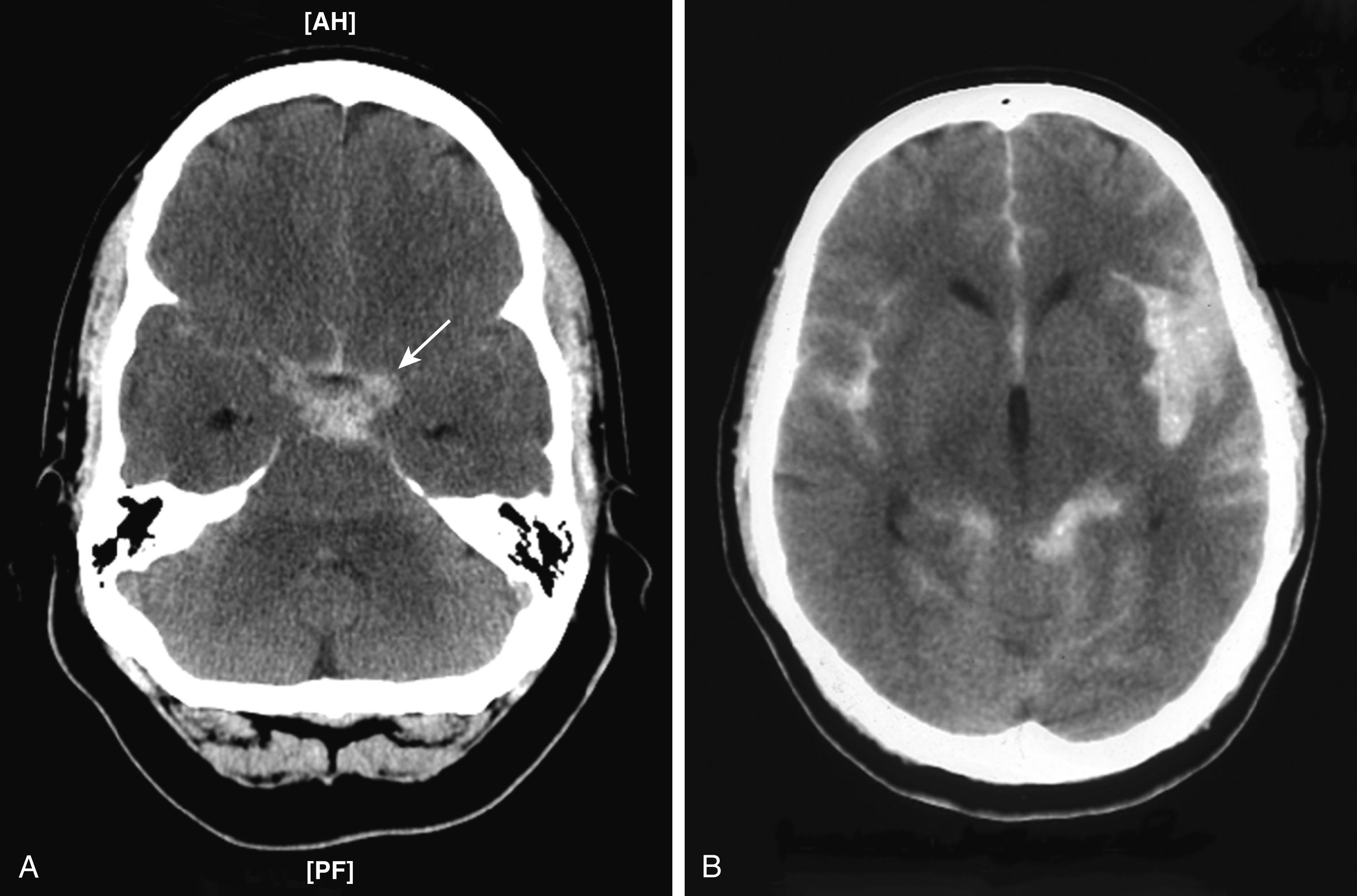 FIGURE 377-3, Two CT images of subarachnoid hemorrhage.