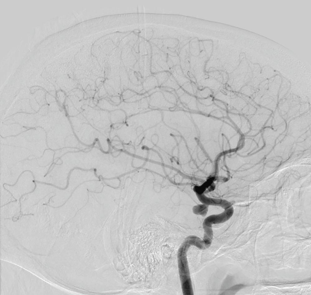 FIGURE 377-4, Cerebral aneurysm.