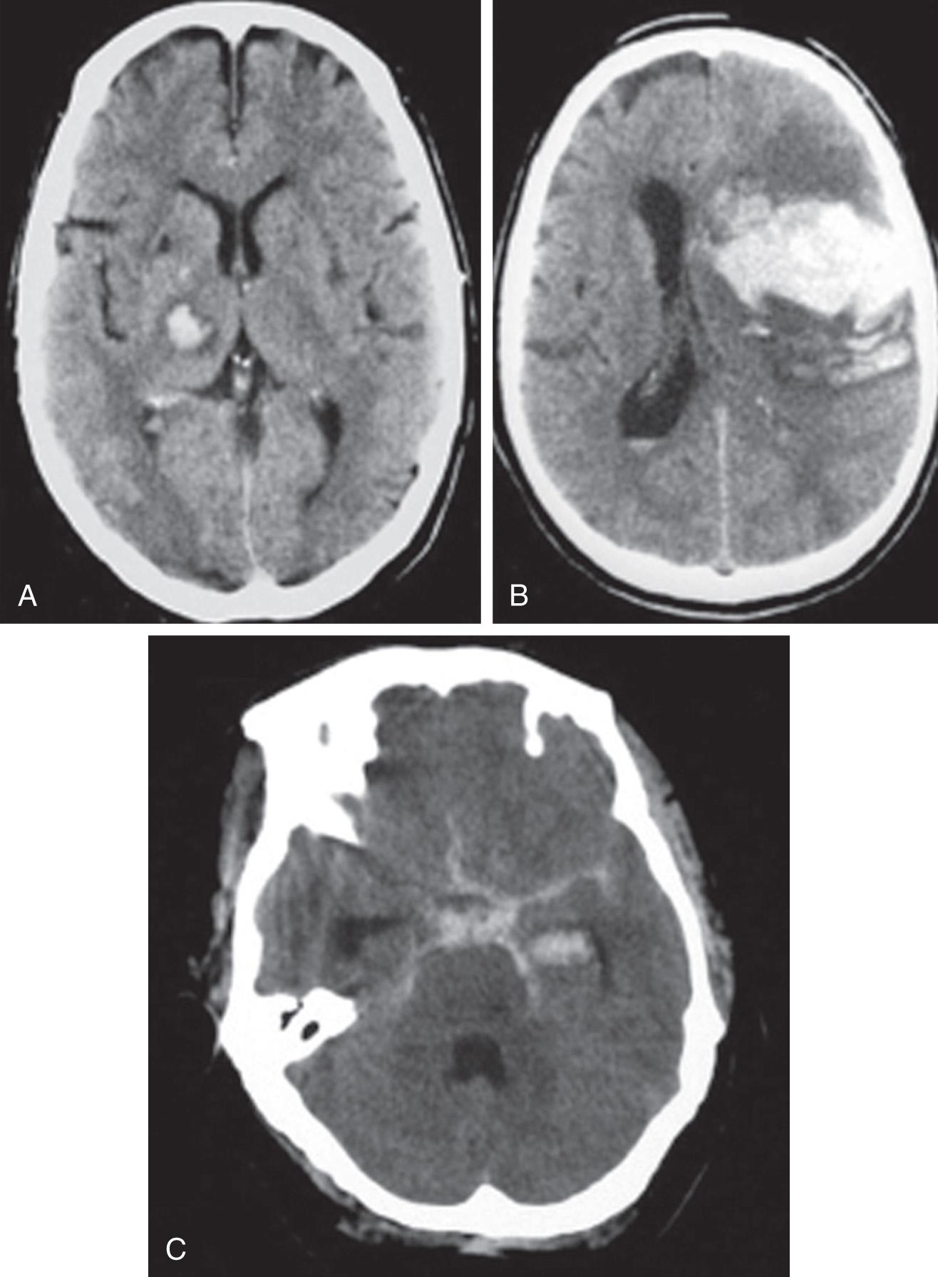 Fig. 60.1, Computed tomography (CT) of the head showing different types of hemorrhagic strokes, with the acute hemorrhage appearing hyperdense. A, Small deep parenchymal intracerebral hemorrhage (ICH) typically seen with uncontrolled hypertension. B, Lobar ICH typically seen with tumor or vascular malformation. C, Subarachnoid hemorrhage typically seen with ruptured berry aneurysm.