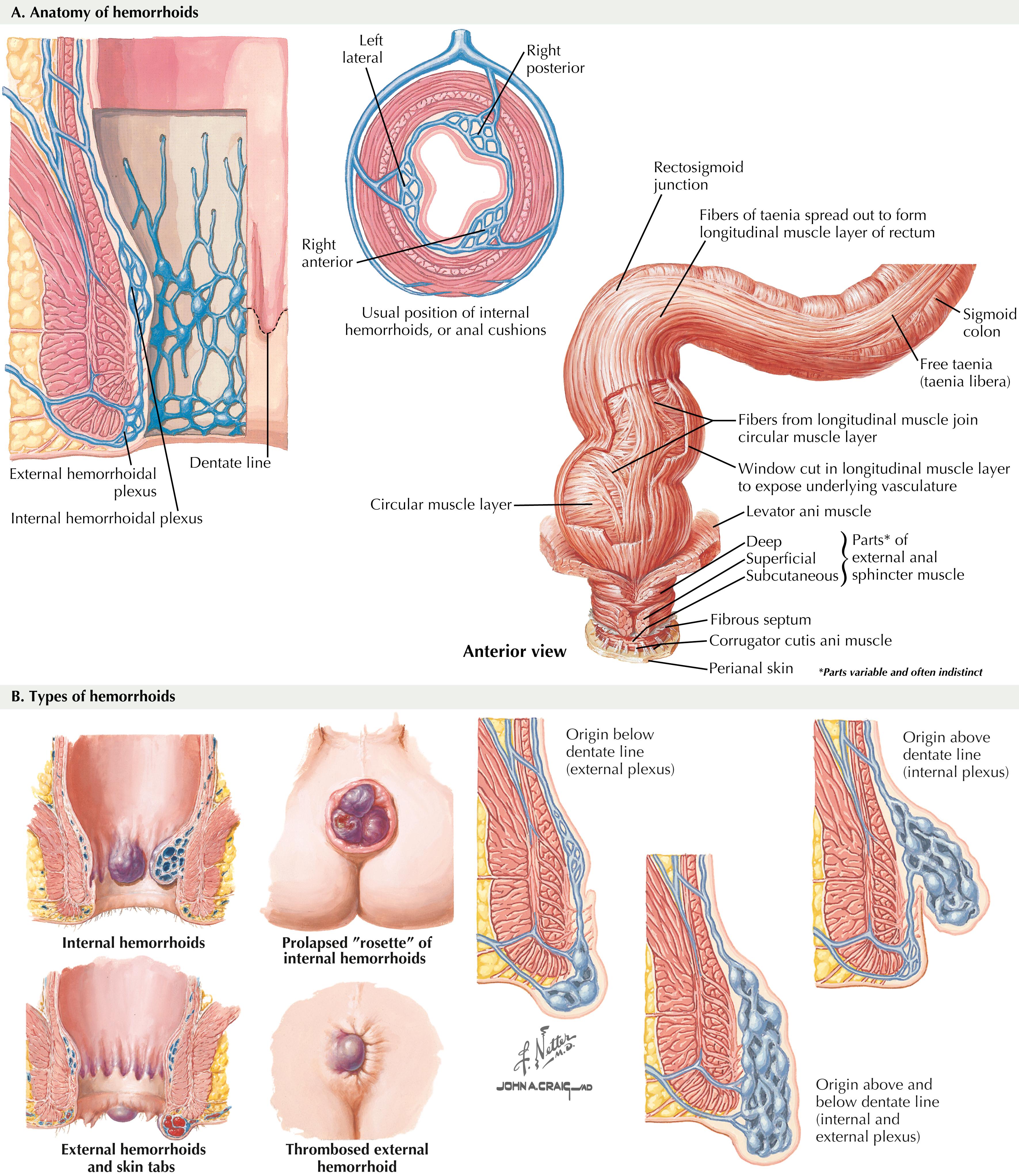 FIGURE 32.1, Anatomy and types of hemorrhoids.