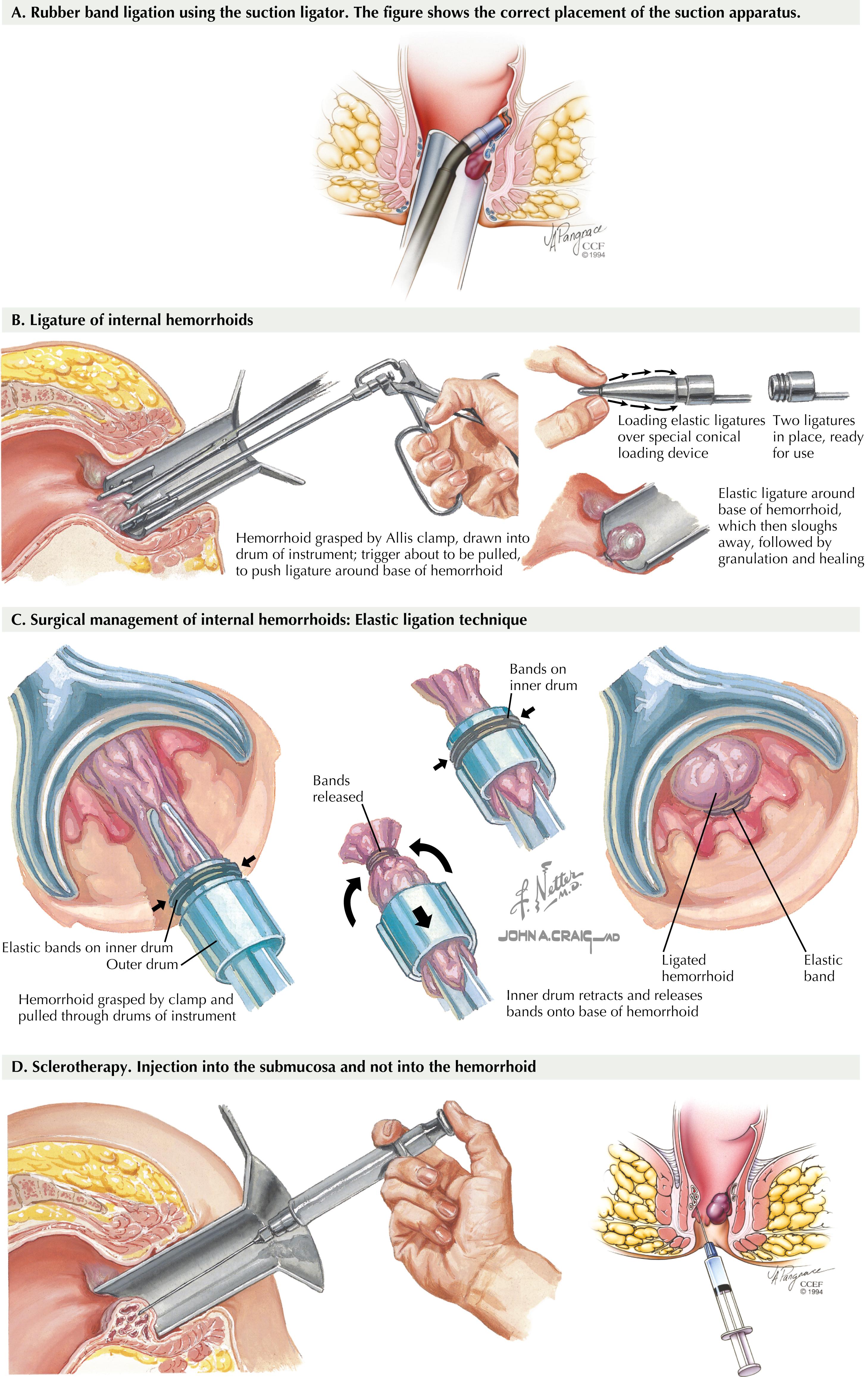 FIGURE 32.2, Office procedures for hemorrhoids.