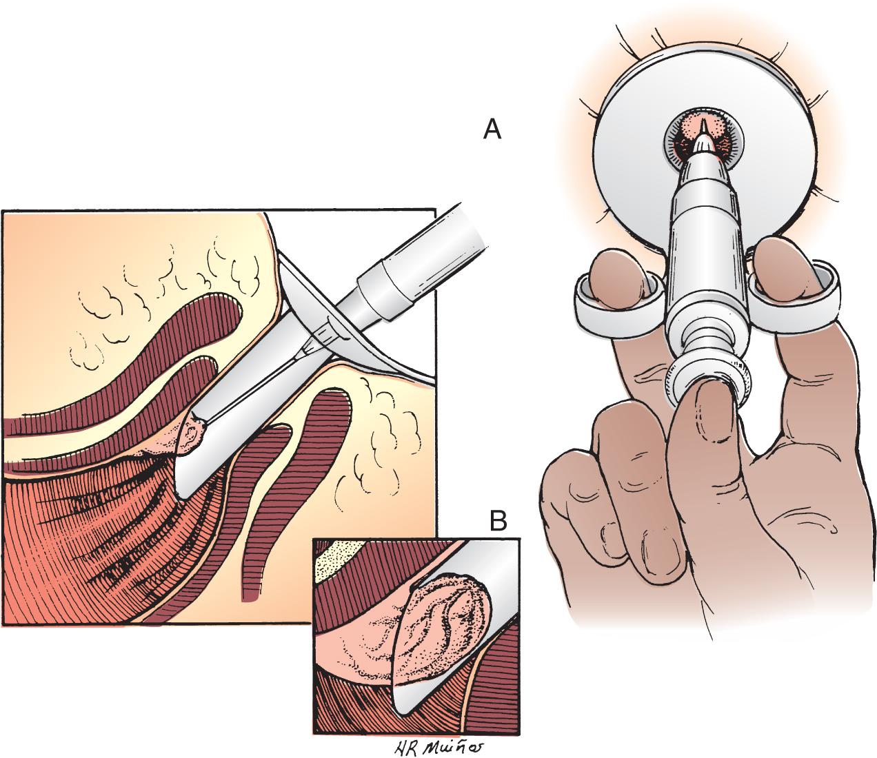 FIGURE 158.1, (A) Injection of internal hemorrhoid. (B) Postinjection striations.