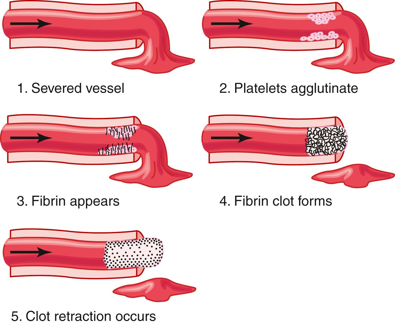 Figure 37-2, Clotting process in a traumatized blood vessel.