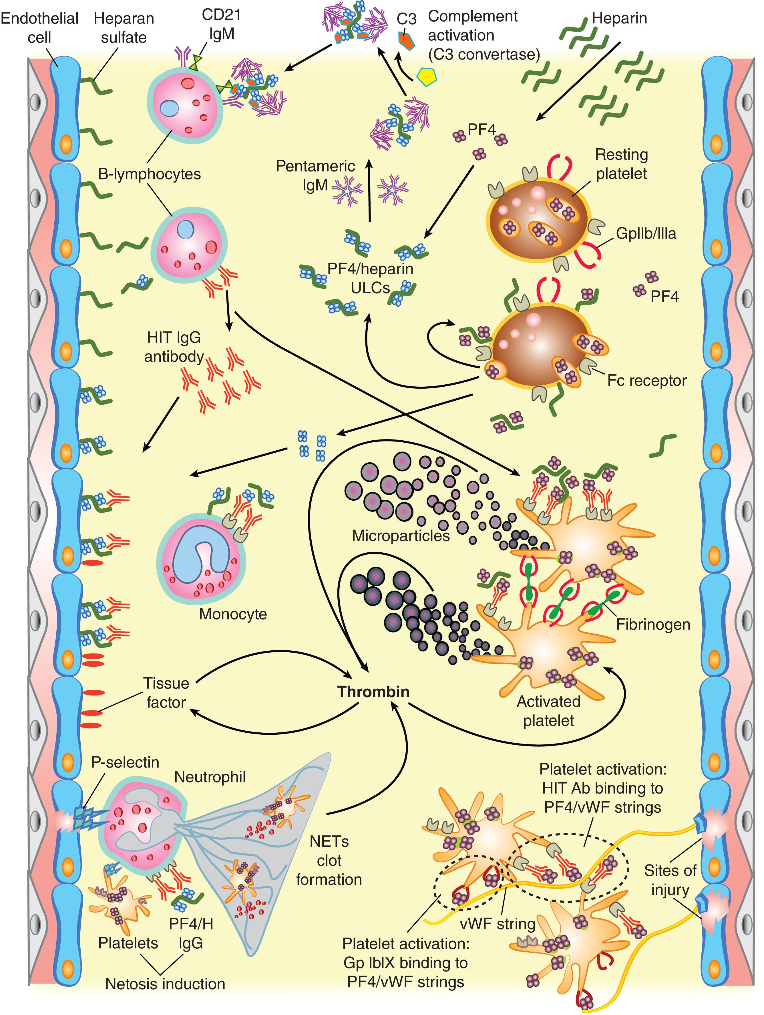 Figure 131.1, PATHOGENESIS OF HEPARIN-INDUCED THROMBOCYTOPENIA: PANCELLULAR ACTIVATION.