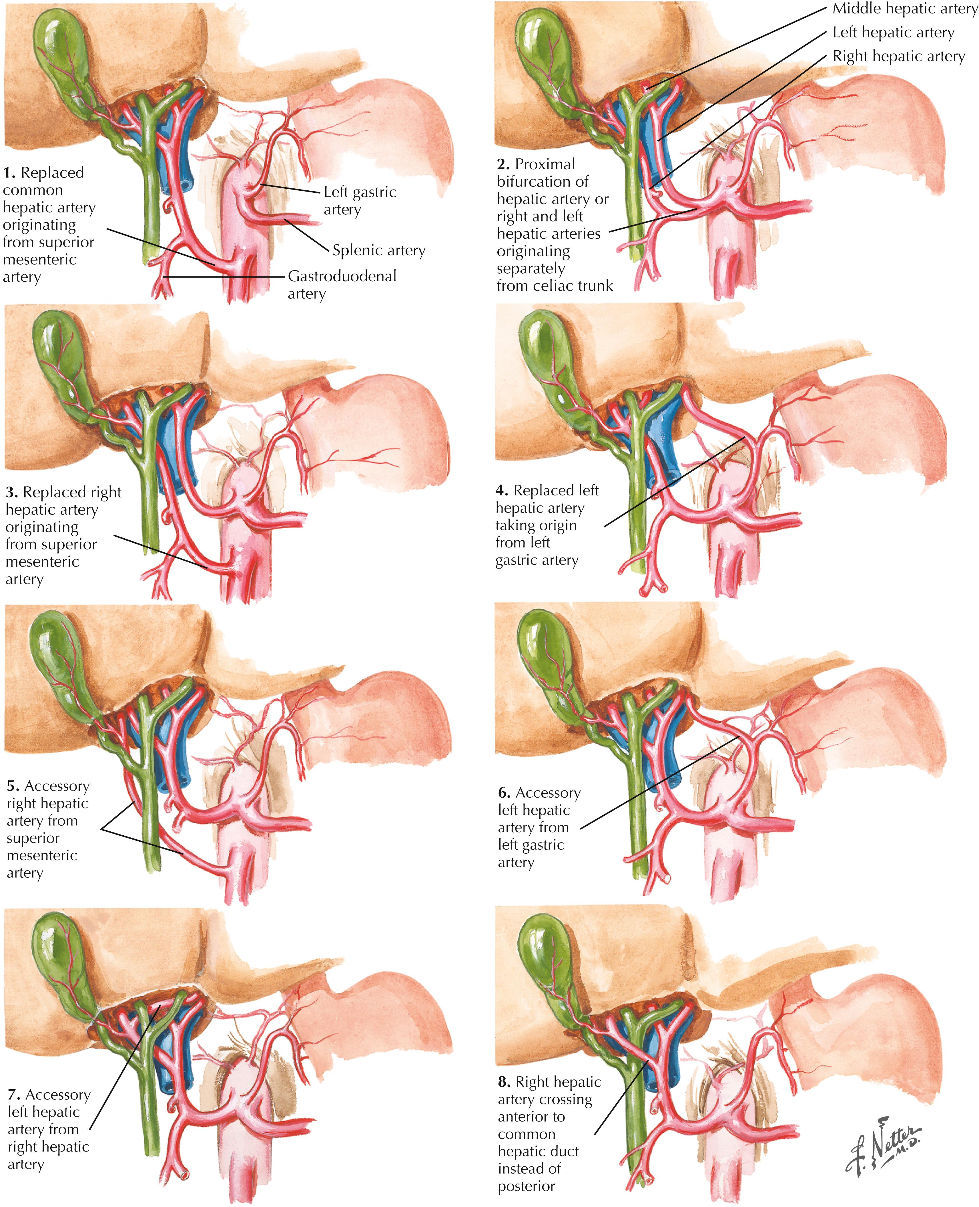 FIGURE 14.2, Variations in origin and course of hepatic artery and branches.