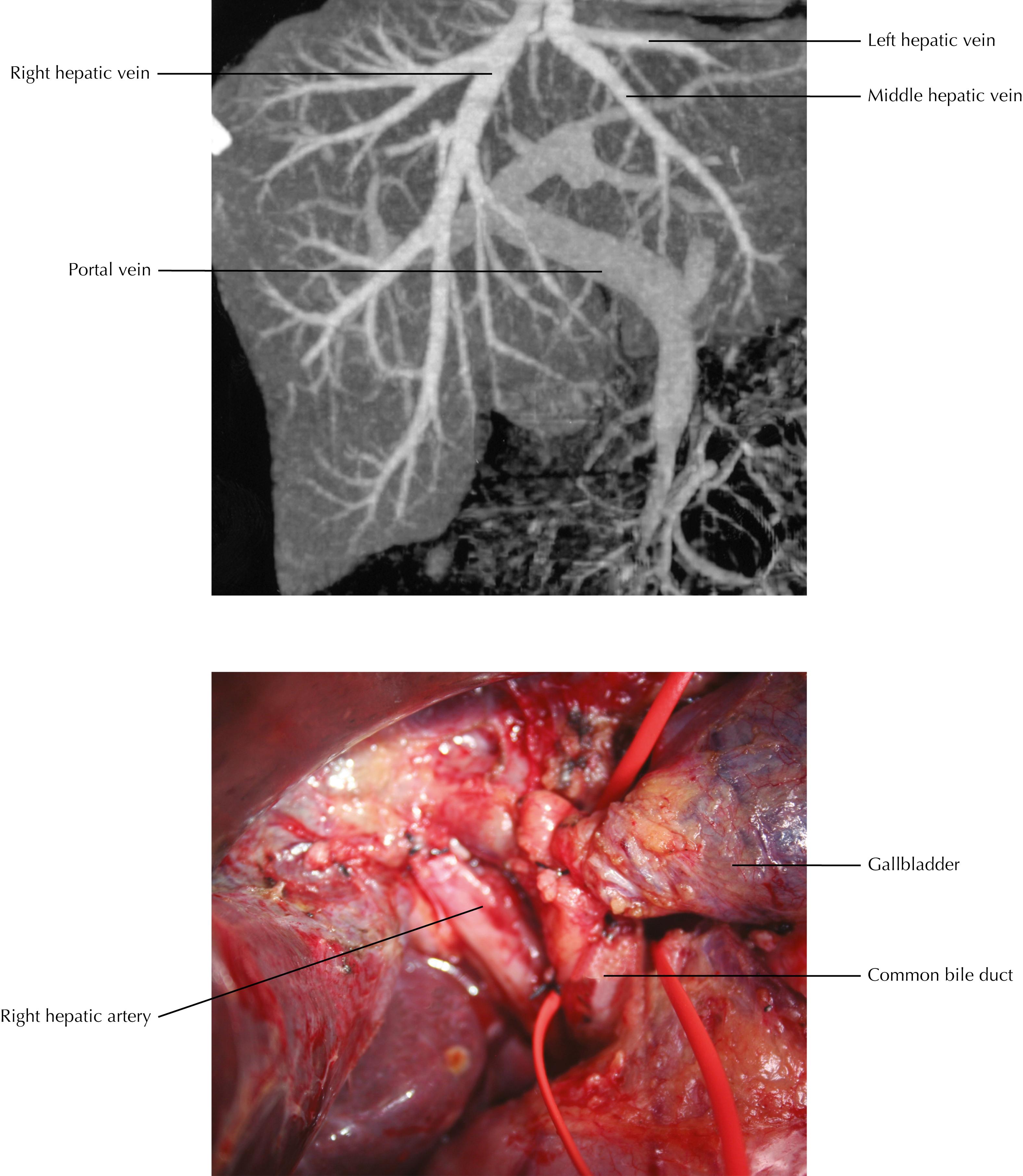 FIGURE 14.3, Liver: magnetic resonance image and surgical view.