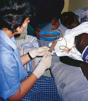 Fig. 30.2, Drainage of an amebic liver abscess in rural Africa.