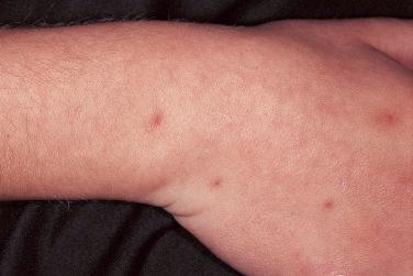 FIGURE 30-2, Spider angioma on the arm and dorsal hand.