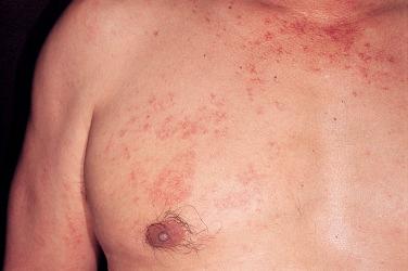 FIGURE 30-3, Unilateral nevoid telangiectasia in a male patient with cirrhosis of the liver due to hepatitis C.
