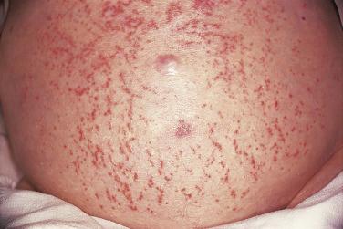FIGURE 30-4, Dilated abdominal wall veins along with xerosis and eczema associated with cirrhosis and portal hypertension.