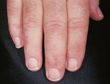 FIGURE 30-5, Terry nails are represented by opaque white changes in this patient with cirrhosis.