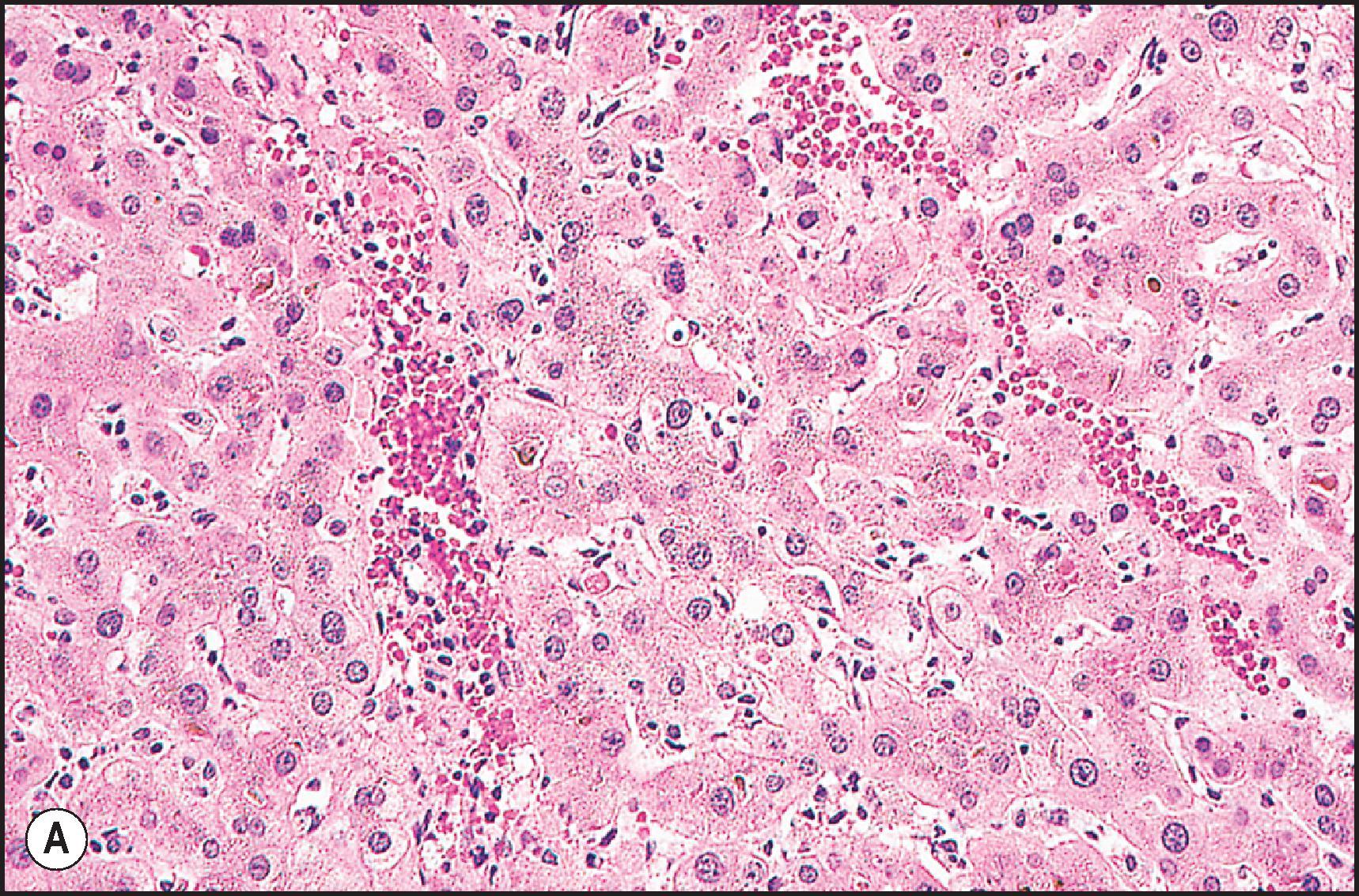 Figure 12.11, Erythromycin estolate injury. (A) Marked cholestasis in perivenular zone. Note acidophilic body, mild to moderate ballooning and anisonucleosis. (H&E.) (B) Moderate portal inflammation with many eosinophils. Note mitoses to the left. (H&E.)